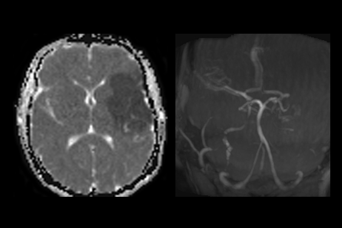 ADC MRI Aniography سی تی اسکن  سکته مغزی